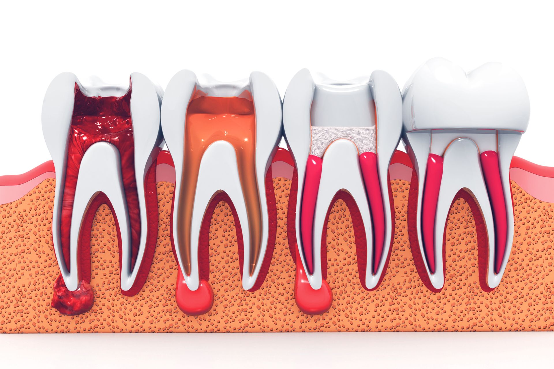 Dental disease stages showing healthy tooth, decay, root infection, gum inflammation and crown restoration.