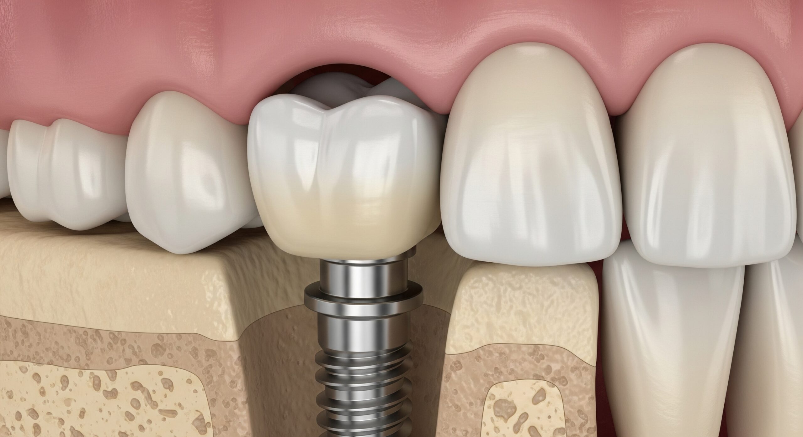 3D illustration of a dental implant with a crown integrated into the jawbone beside natural teeth.