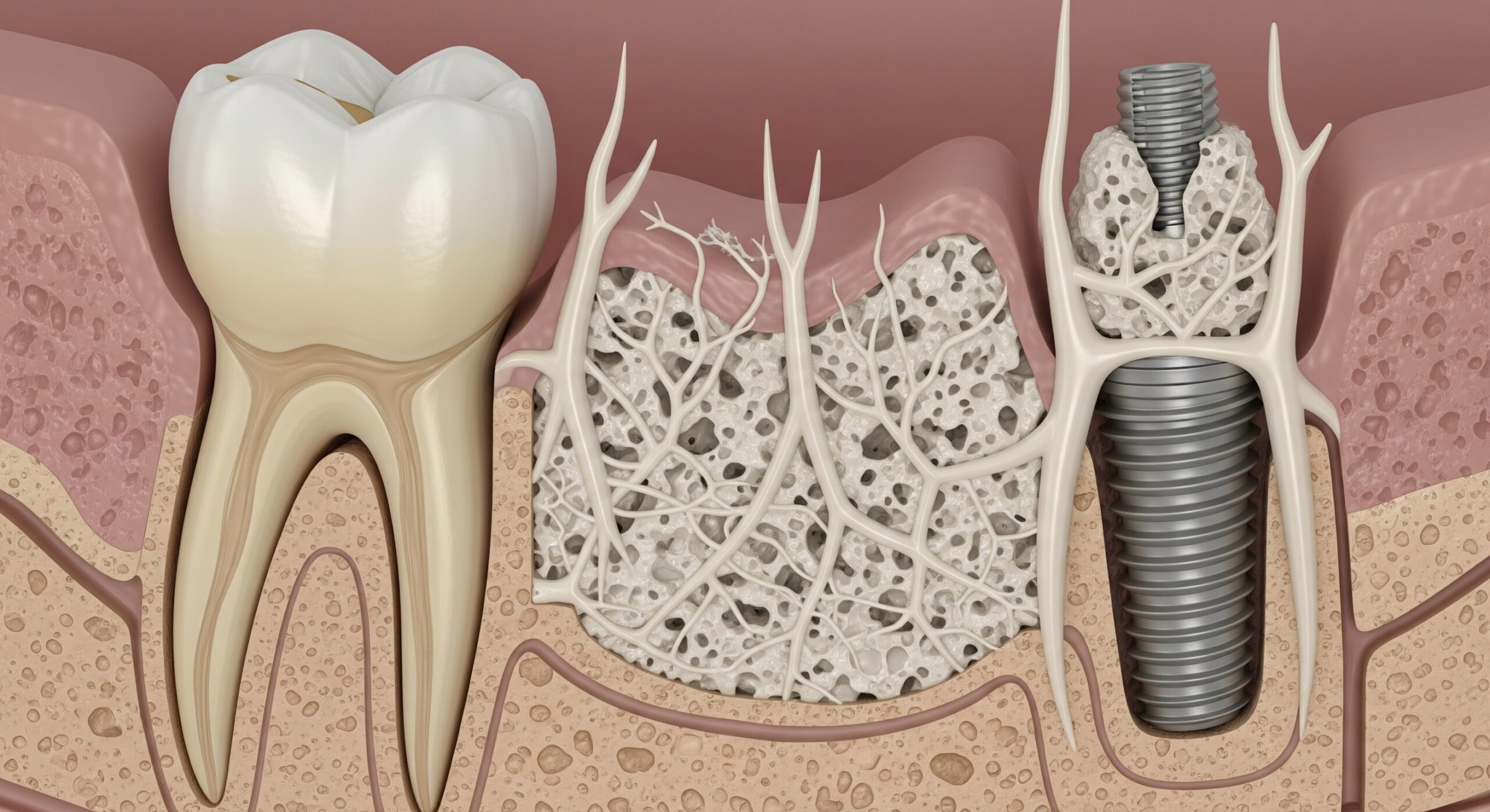 Illustration showing bone graft integration around a dental implant beside a natural tooth within the jawbone.