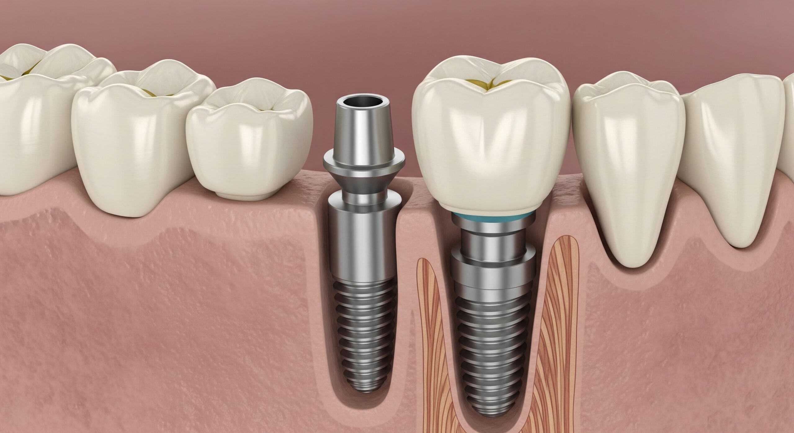 Illustration of a dental implant showing the titanium post, abutment, and attached crown in the jawbone.