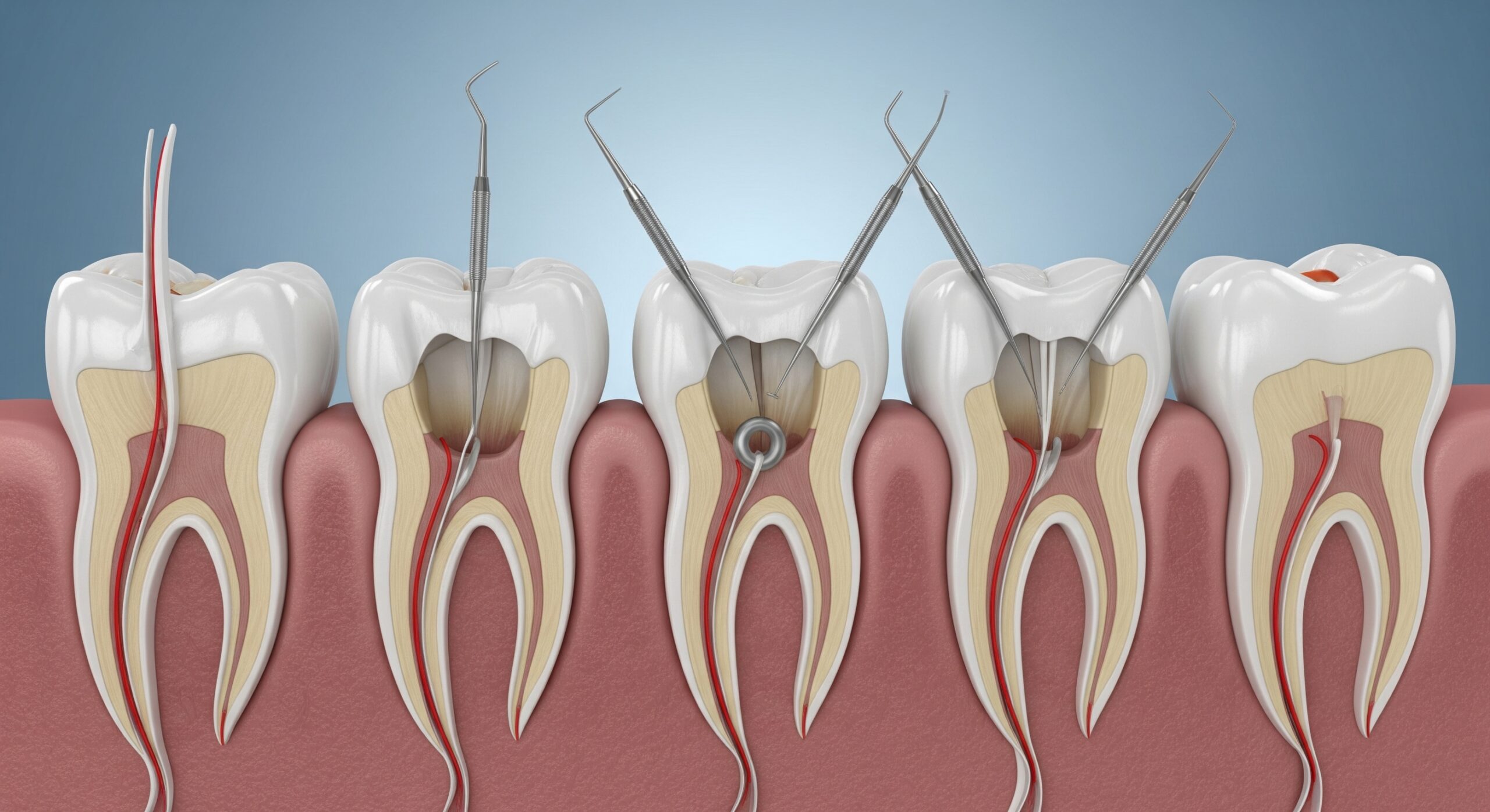 Detailed graphic of root canal therapy highlighting canal access, cleaning, and shaping.