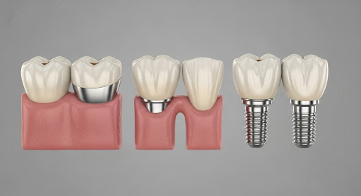 Dental restorations: crown, abutment, bridge span, and two implant fixtures in a detailed 3D medical illustration image.