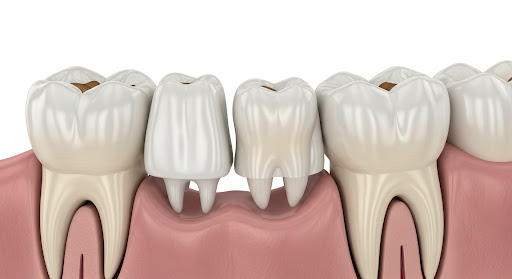 3D dental illustration showing two prepared abutment teeth ready for the placement of a dental bridge.